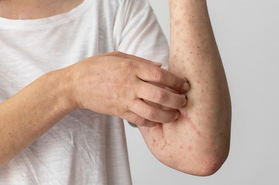 Virus MVOX Menyebar dengan Cepat: Apa&hellip;